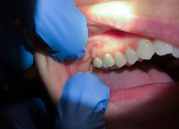 Best Emergency Dentist for Lost Fillings or Crowns in Lyons, GA